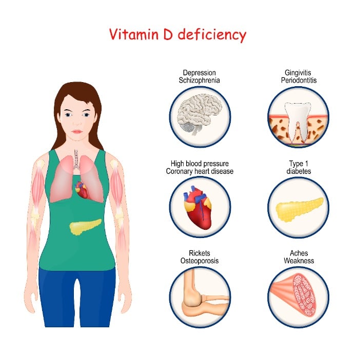 Vitamin D deficiency can lead to several bodily disfunctions