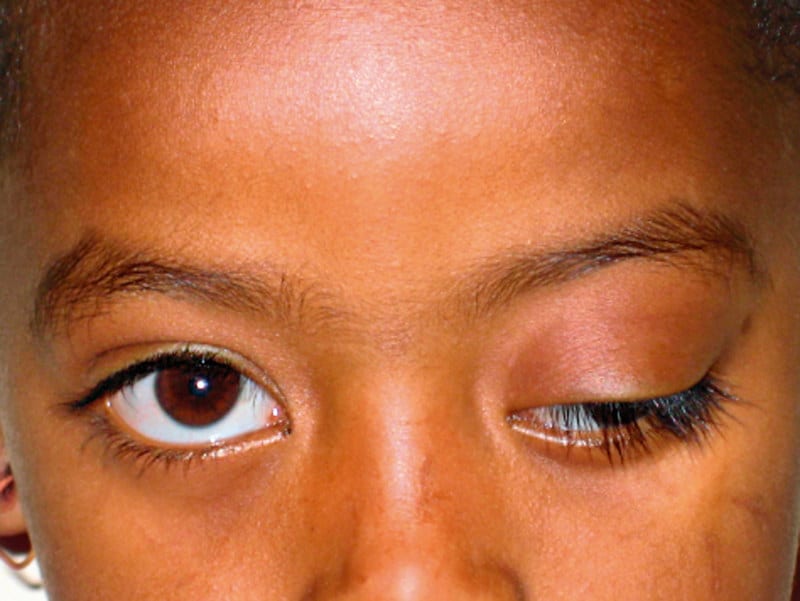 Ptosis is the condition in which an eyelid becomes droopy because nerves are not functioning properly.
