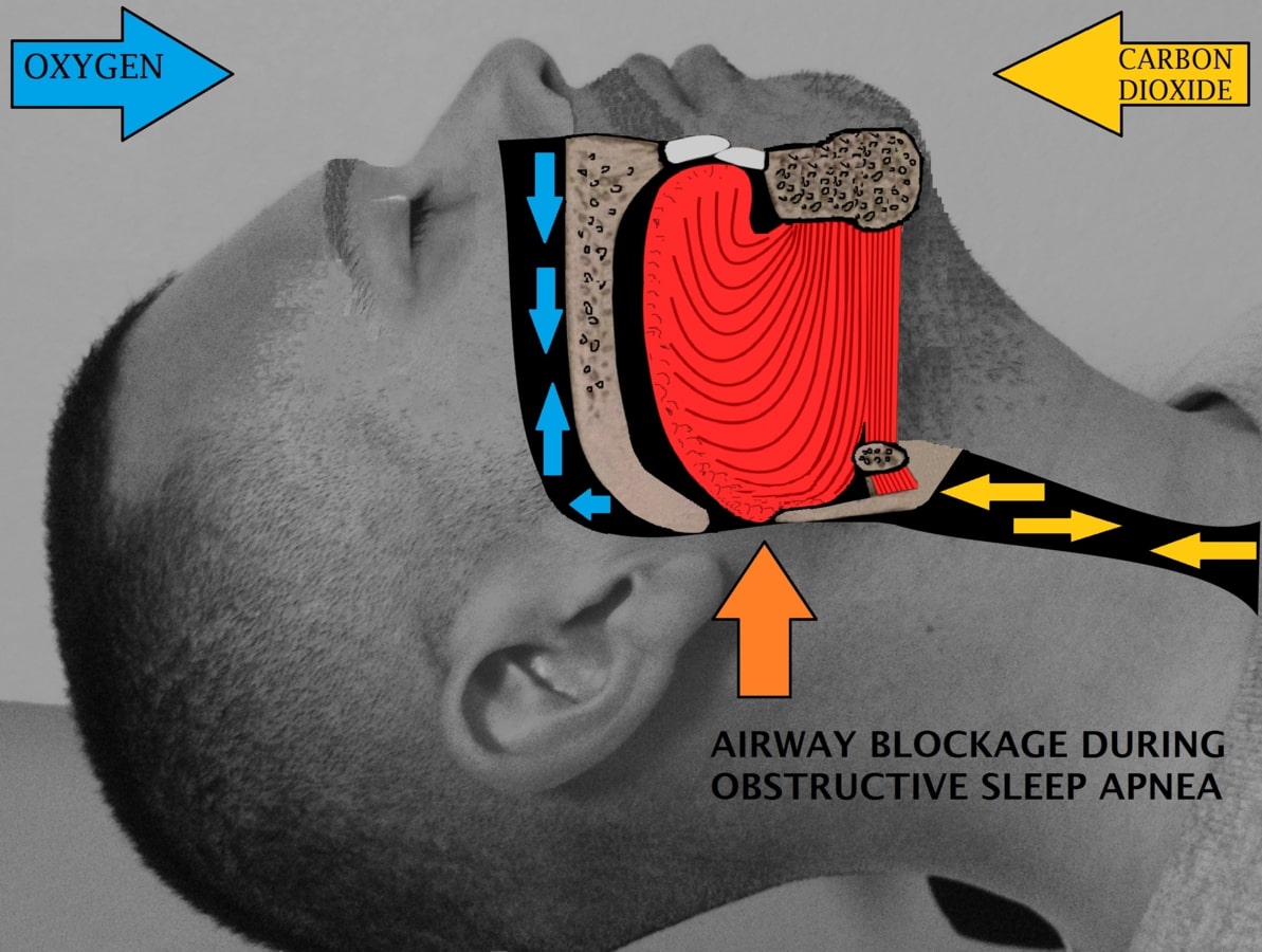 Airway_obstruction