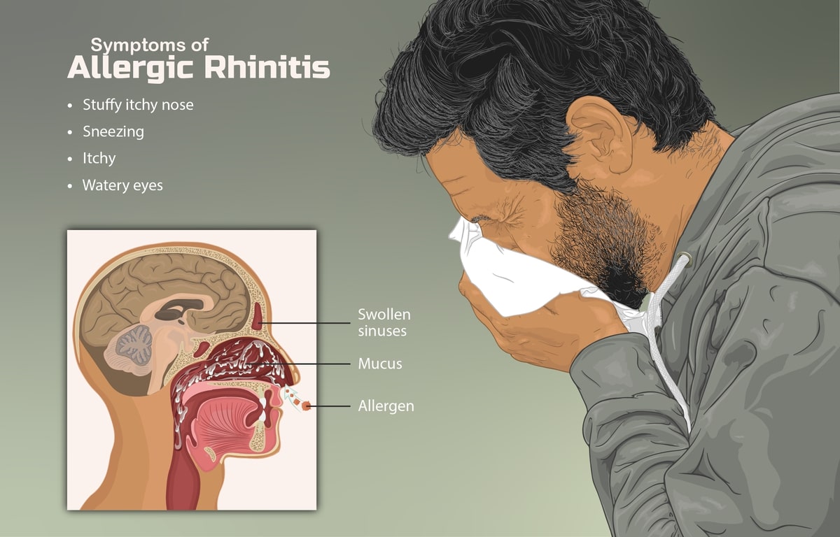Allergic rhinitis
