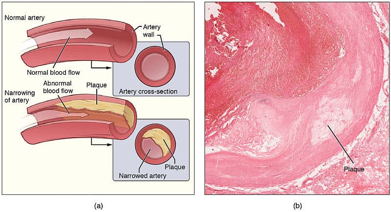 Atherosclerosis