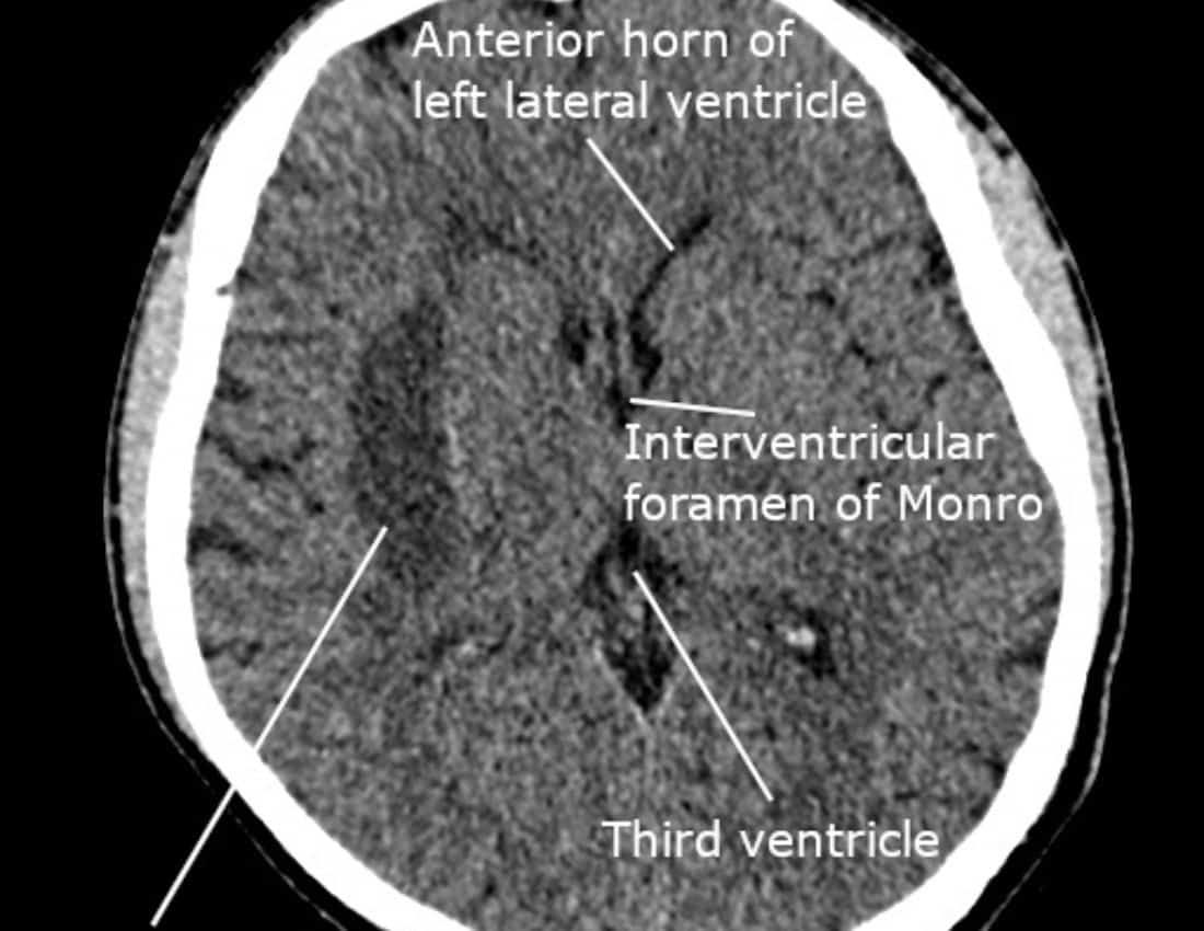 CT_scan_of_the_brain_showing_recent_right_basal_ganglia_bleed