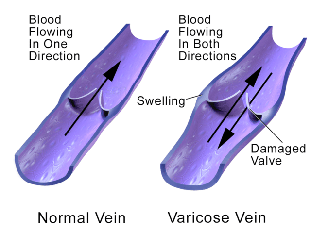 Blausen_0891_VaricoseVein