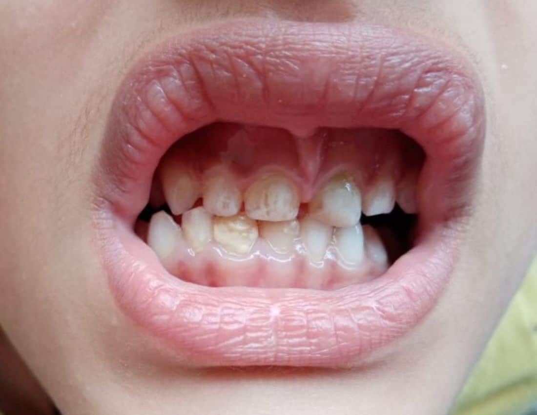 Teeth Stain