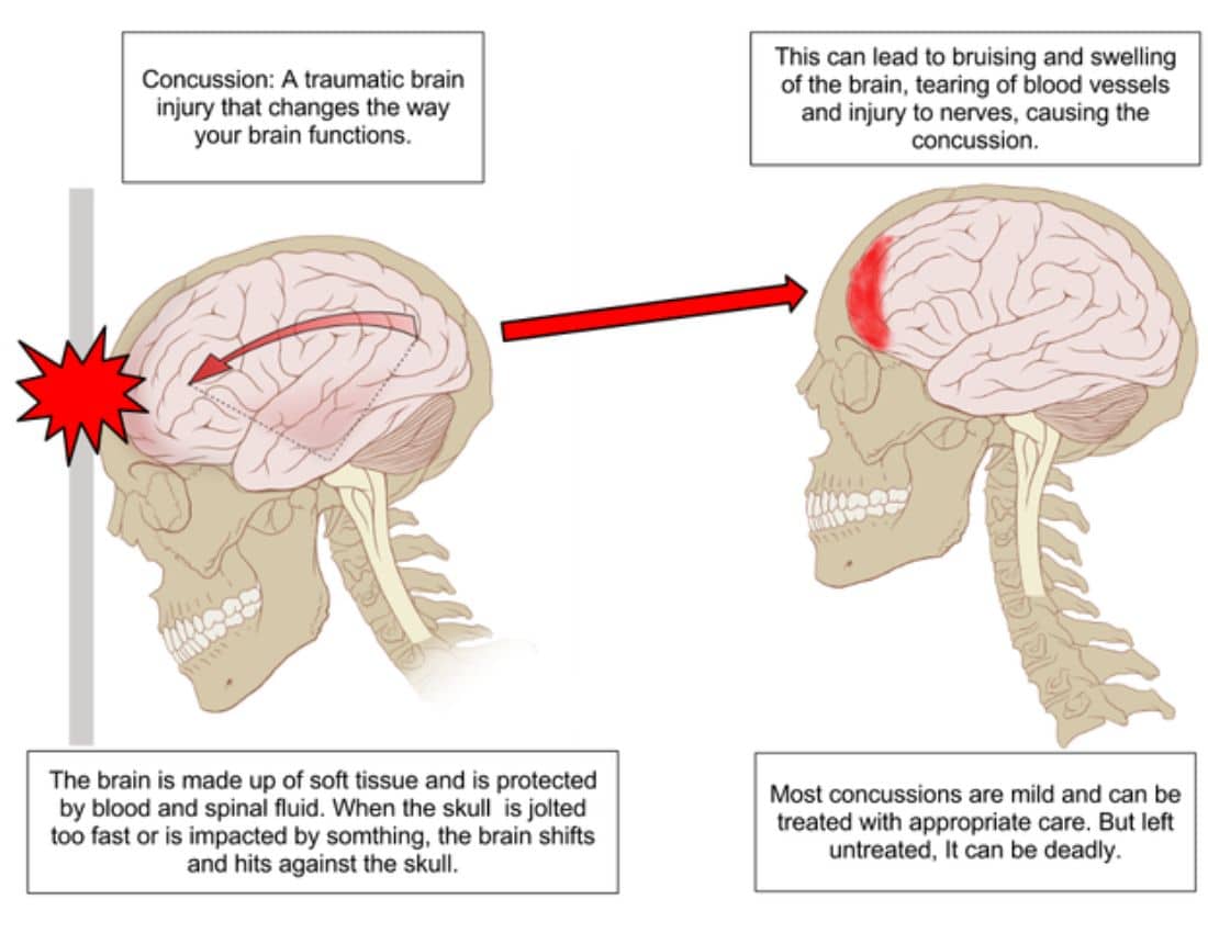 Illustration of a Concussion