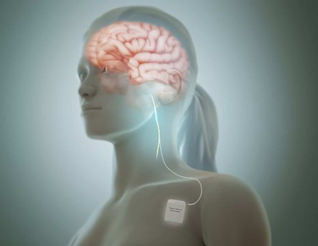 Vagus nerve stimulation