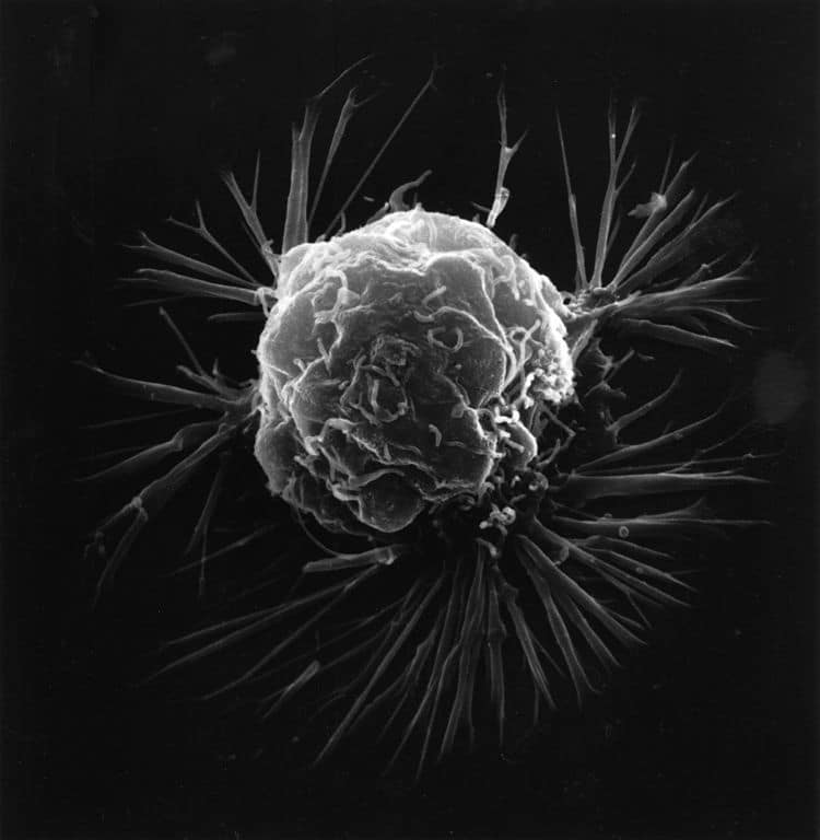 Breast_cancer