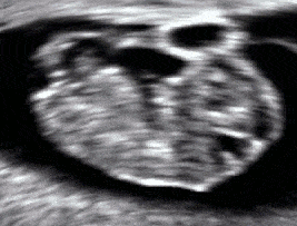 Movements_at_gestational_age_of_9_weeks