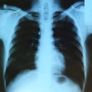 Lung X-ray
