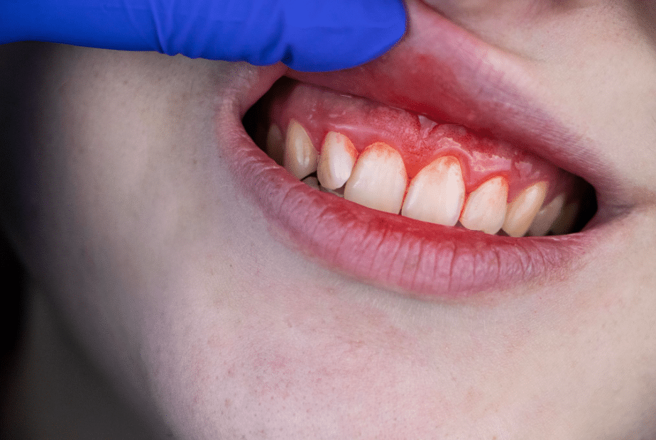 Dont Lose Your Smile Over Gum Problems Tropical Fruit Extracts Fix Damaged Gums